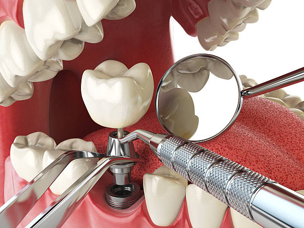 Best Broken or Chipped Tooth Repair in North Bethesda, MD